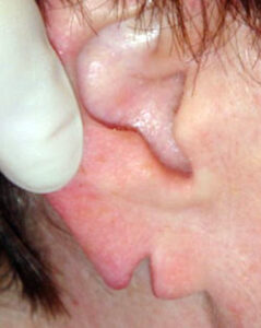Antes