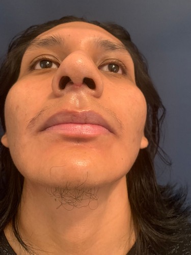 Cicatrice de rhinoplastie ouverte par ultrasons Cicatrice de rhinoplastie ouverte par ultrasons