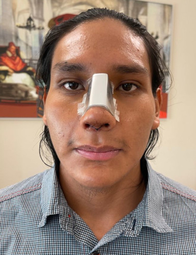 Rhinoplastie ultrasonique - résultat après 3 jours Rhinoplastie ultrasonique - résultat après 3 jours
