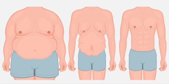 Abdominoplastie