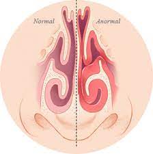 Hypertrophy of the nasal turbinates