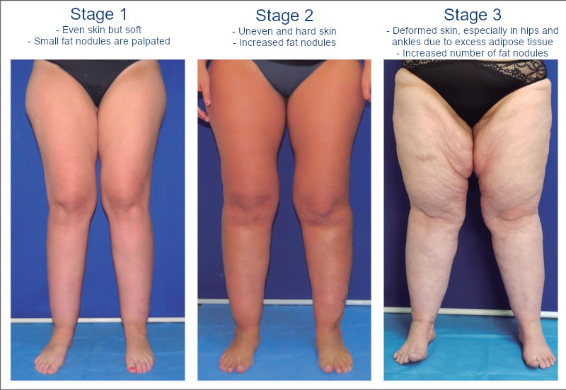 Lipedema stages