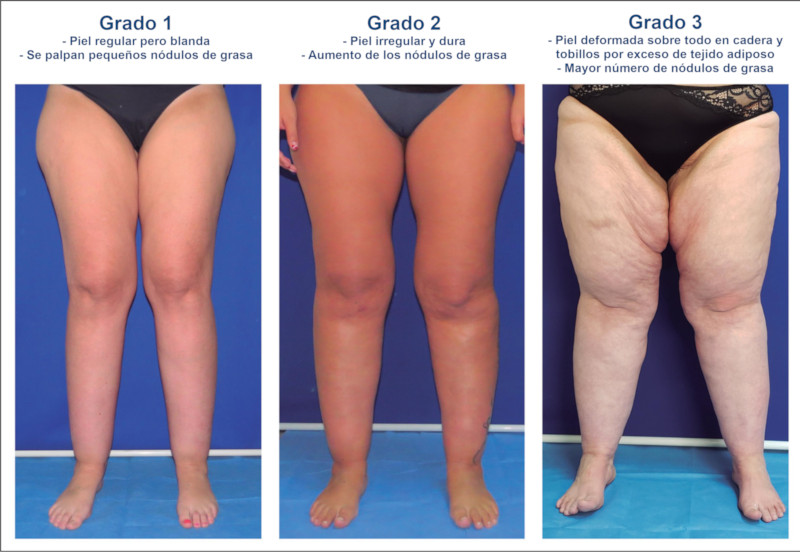 Grados de Lipedema