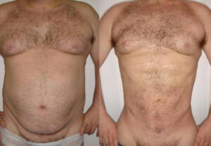 How does the skin look before and after a liposuction?