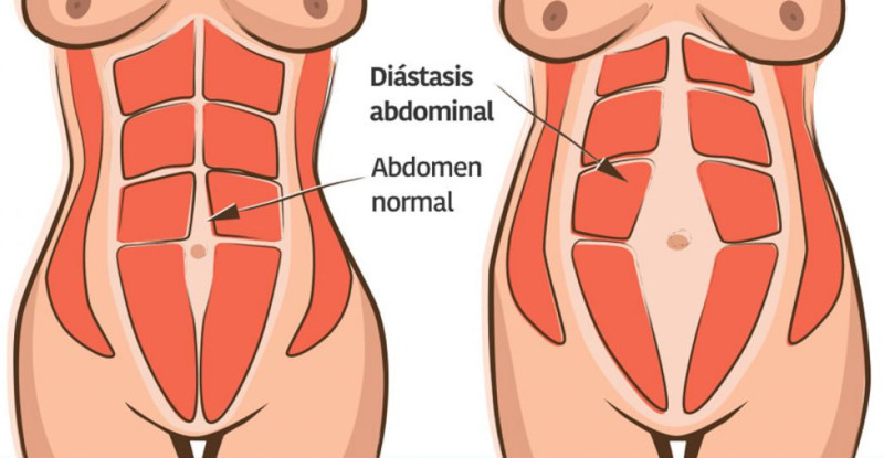 Diàstasis de rectes abdominals