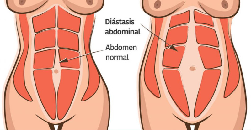 Rectus abdominal diastasis Rectus abdominal diastasis