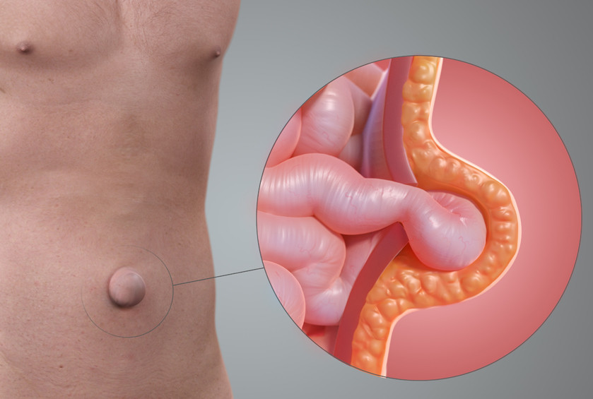Umbilical hernia Umbilical hernia