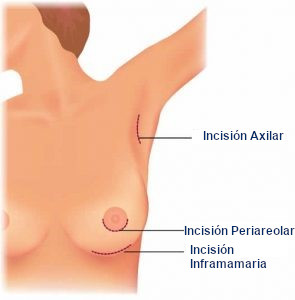 Nombre de las cicatrices mamarias en función de dónde se encuentran