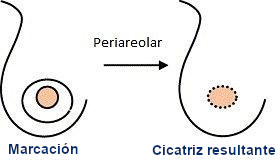 cicatrices mamarias - cicatriz periaerolar