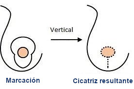 cicatrices mamarias - cicatriz en forma de I