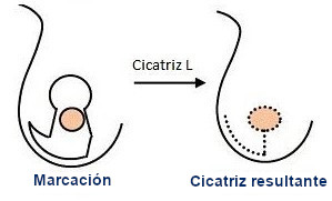 cicatrices du sein - cicatrices en forme de J ou de L