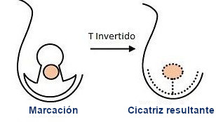 cicatrices du sein - cicatrices en forme de T inversé