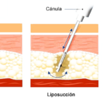 Liposuccion haute définition (HD) de l'abdomen et du dos