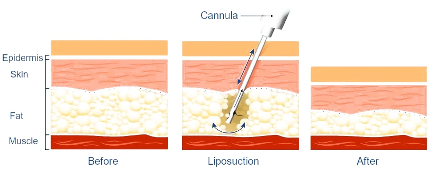 Liposucción - extraccion de grasa