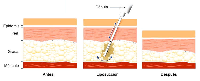 Liposuccion - élimination de la graisse