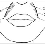 Gráfico de relleno de surco nasogeniano