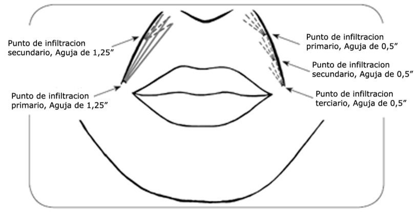 Gráfico de relleno de surco nasogeniano