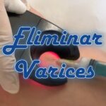 Esclerosar Varices en Barcelona