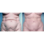 Abdominoplastia antes y después