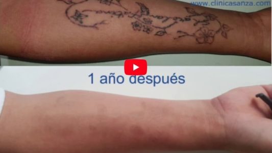 Eliminar tatuajes con láser - copia