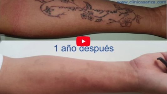 Eliminar tatuajes con láser Eliminar tatuajes con láser