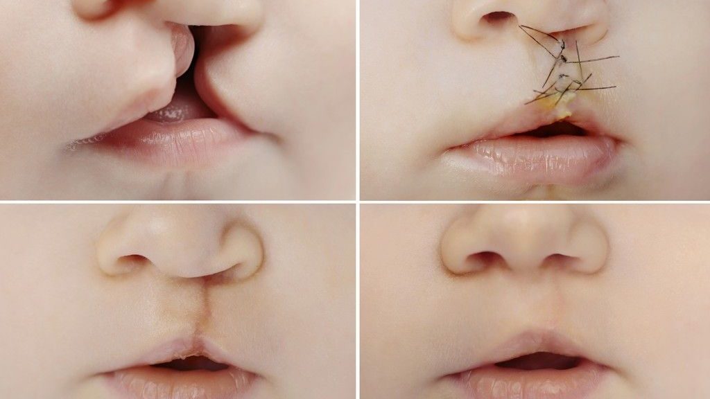 reconstruccion de labios reconstruccion de labios