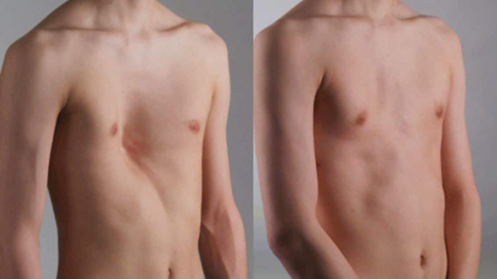reconstrucción de pectorales – foto 4 reconstrucción de pectorales - foto 4
